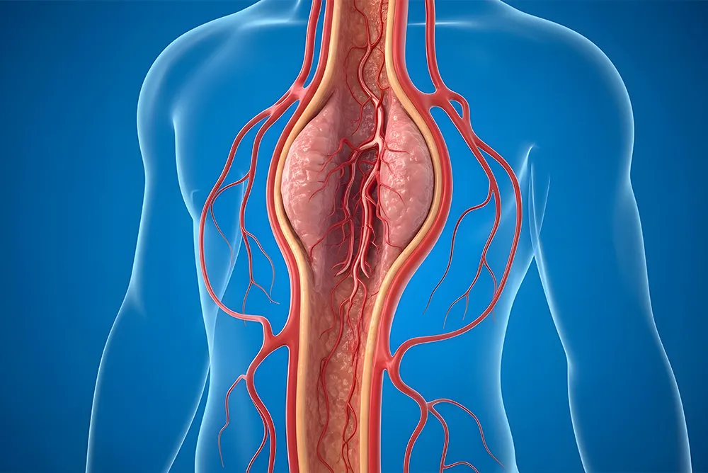Illustration d&rsquo;un an&eacute;vrysme de l&rsquo;aorte abdominale montrant une dilatation pathologique de l&rsquo;art&egrave;re