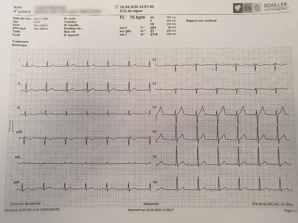 Trac&eacute; d&rsquo;&eacute;lectrocardiogramme montrant l&rsquo;activit&eacute; &eacute;lectrique du c&oelig;ur enregistr&eacute;e sur papier