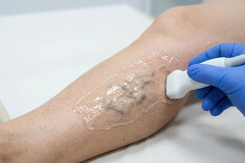 &Eacute;cho-Doppler veineux d&rsquo;une jambe pour le diagnostic et le suivi de l&rsquo;insuffisance veineuse chronique