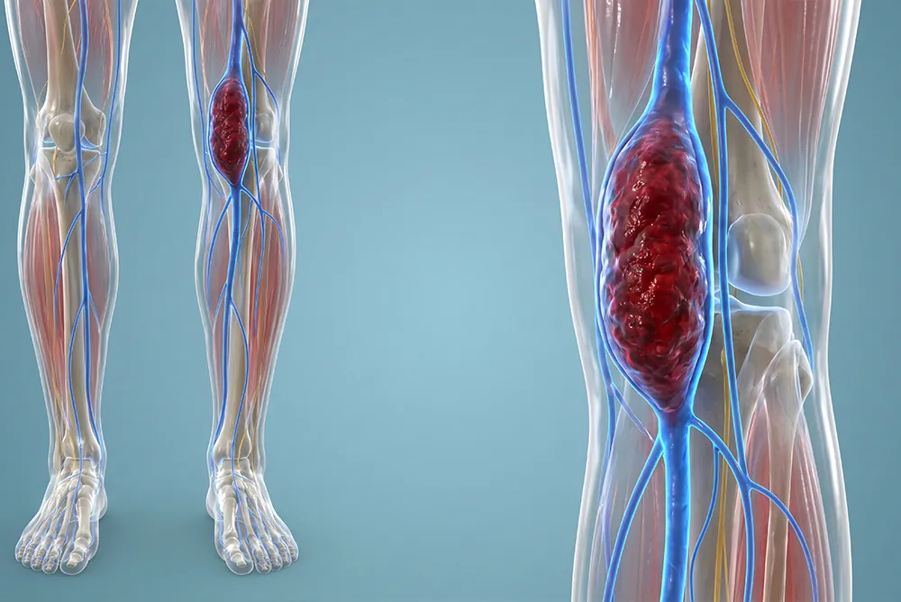 Illustration d&rsquo;une phl&eacute;bite de la jambe montrant un caillot sanguin dans une veine profonde du membre inf&eacute;rieur