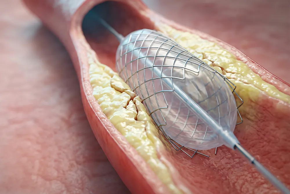 Stent coronaire d&eacute;ploy&eacute; dans une art&egrave;re pour r&eacute;tablir la circulation sanguine apr&egrave;s un r&eacute;tr&eacute;cissement