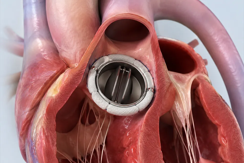 Proth&egrave;se valvulaire cardiaque implant&eacute;e au niveau de la valve aortique pour restaurer la circulation sanguine