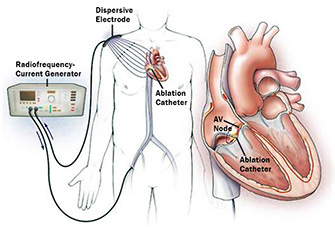 Ablation cath&eacute;ter