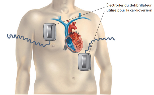 Cardioversion electrique externe