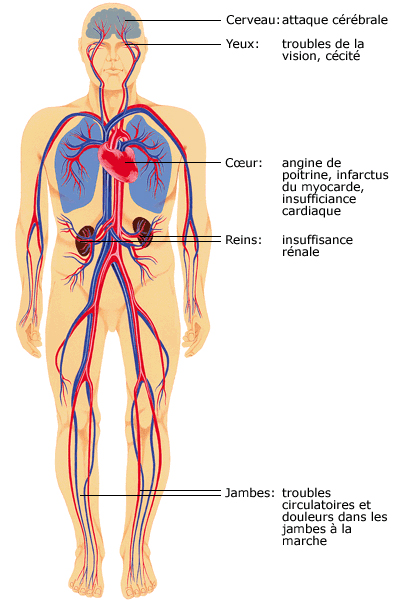 Complications hypertension