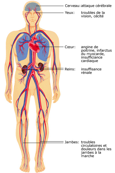 Possibles complications d’une hypertension artérielle