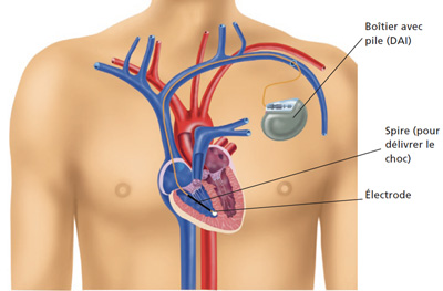 Composition défibrillateur cardiaque