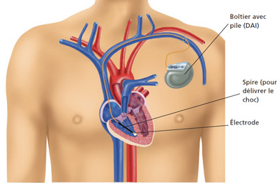 Défibrillateur automatique implantable – Institut de cardiologie