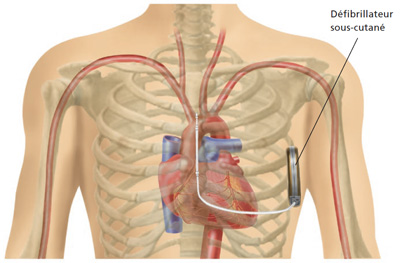 Comment utiliser un défibrillateur cardiaque ?