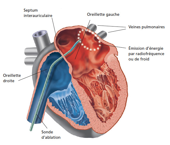 Ablation fibrilation atrial