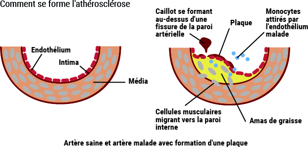 Formation de l'arthérosclérose