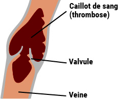 Phlébite