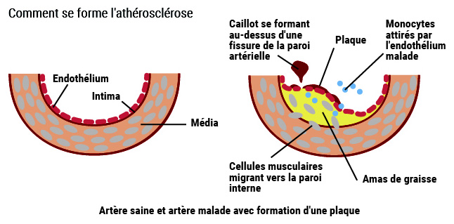Schéma athérosclérose
