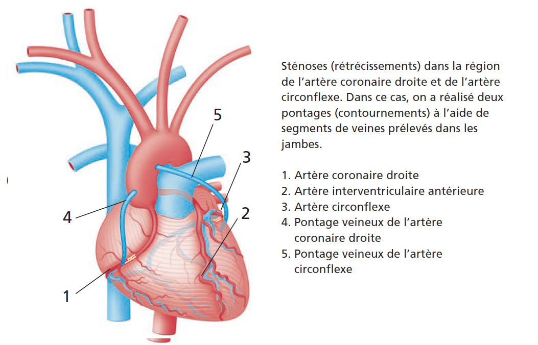 Sténose arthère coronaire droite