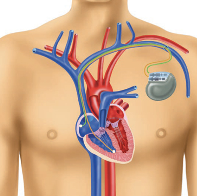 Stimulateur cardiaque